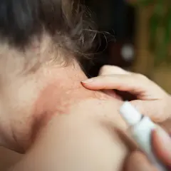 Utslag på nacken, möjligtvis relaterat till glutenintolerans. En hand applicerar salva på det irriterade hudområdet.