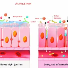 Illustration visar en frisk tarm med täta cellförbindelser och en läckande tarm där dåliga bakterier, virus och gifter passerar in i blodflödet, vilket orsakar inflammation.