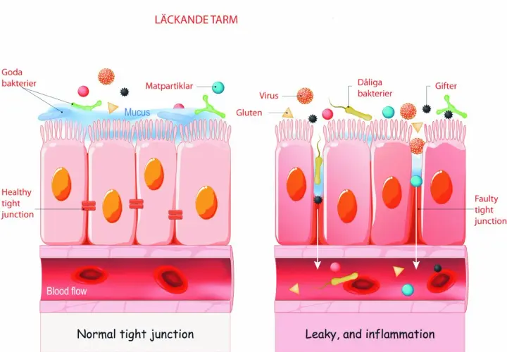 Illustration visar en frisk tarm med täta cellförbindelser och en läckande tarm där dåliga bakterier, virus och gifter passerar in i blodflödet, vilket orsakar inflammation.