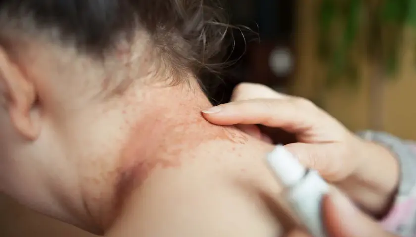 Utslag på nacken, möjligtvis relaterat till glutenintolerans. En hand applicerar salva på det irriterade hudområdet.