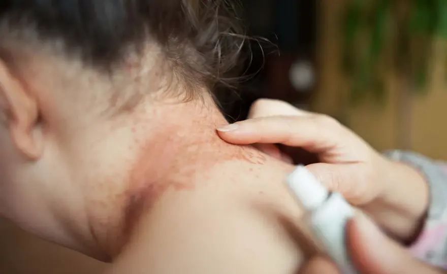 Glutenutslag - Så skiljer du dem från eksem och allergi