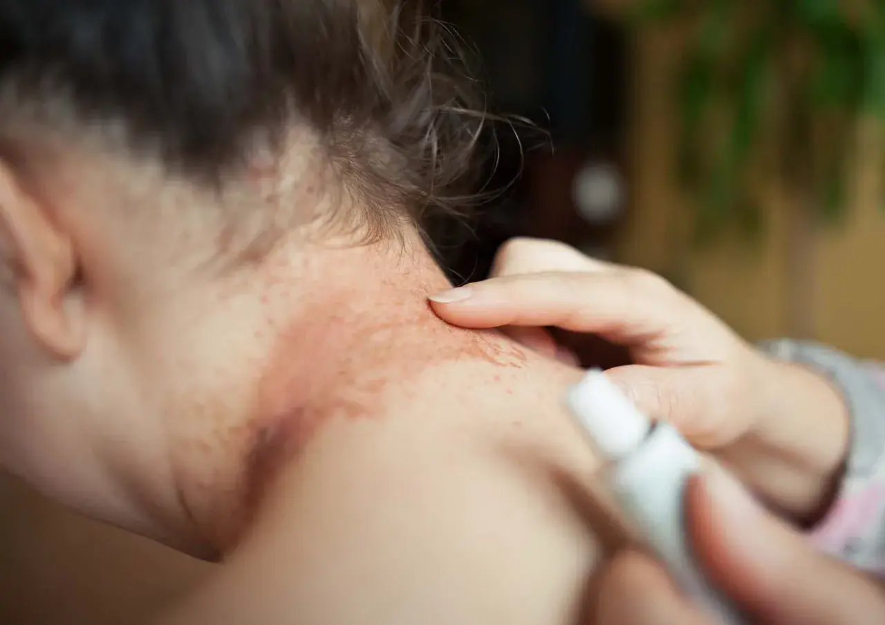 Utslag på nacken, möjligtvis relaterat till glutenintolerans. En hand applicerar salva på det irriterade hudområdet.