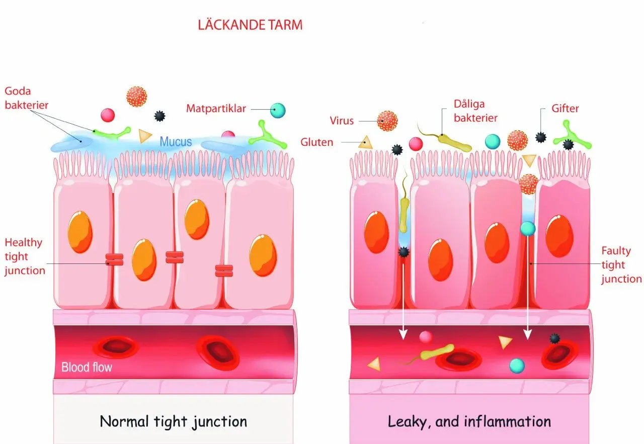 Illustration visar en frisk tarm med täta cellförbindelser och en läckande tarm där dåliga bakterier, virus och gifter passerar in i blodflödet, vilket orsakar inflammation.