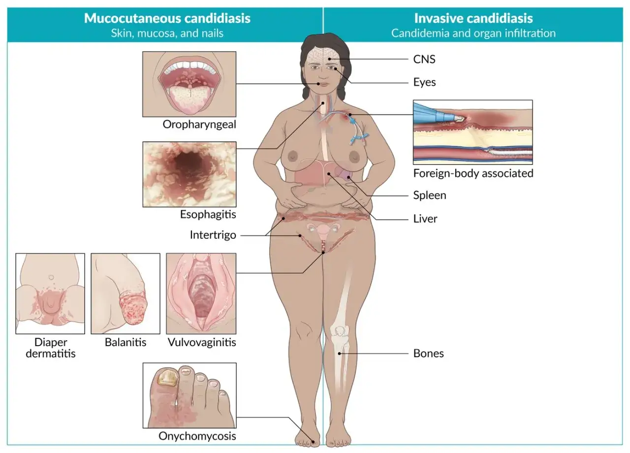 Illustration visar candidainfektion magen och andra kroppsdelar, inklusive hud, svalg, matstrupe, naglar och organ som lever och mj&auml;lte.