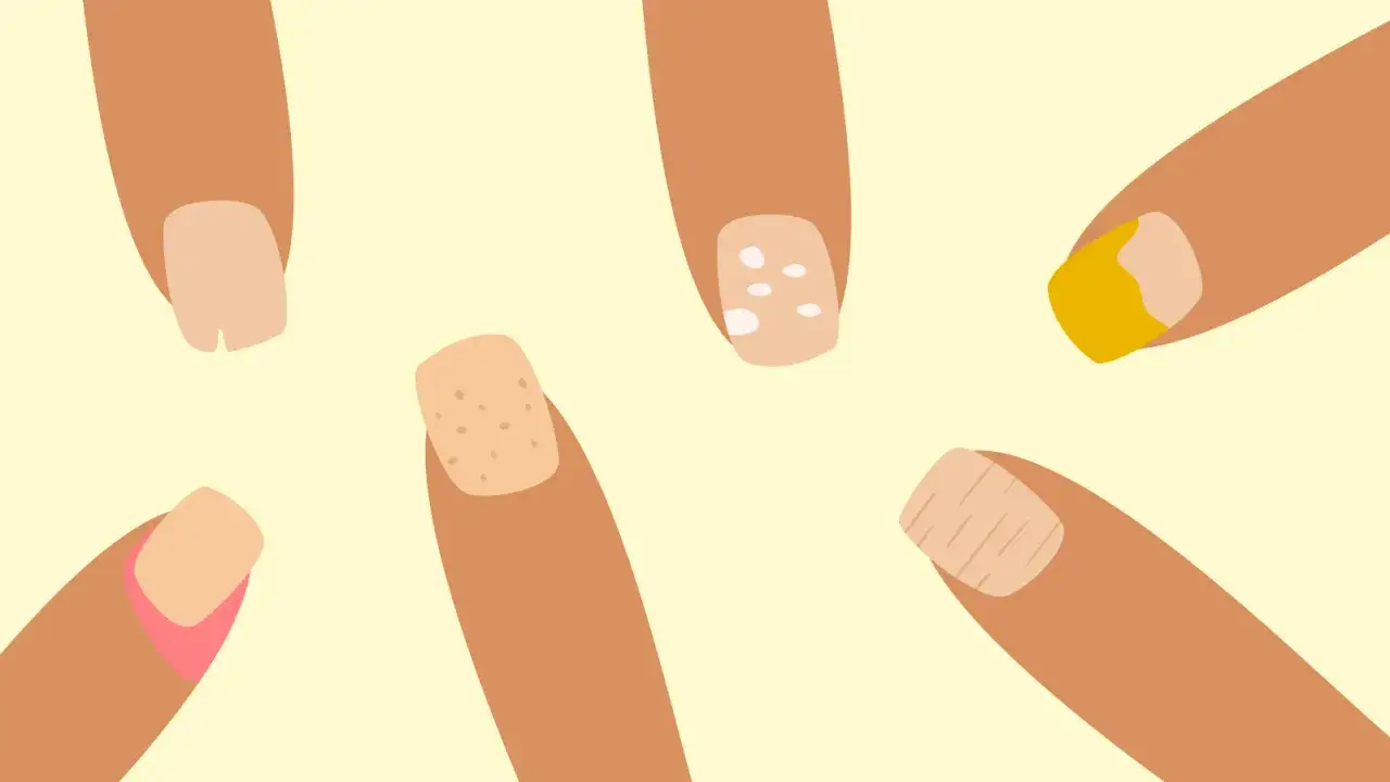 Fingrar med olika nagelproblem som kan vara tecken på mineralbrist: spröda, fläckiga, räfflade och missfärgade naglar.