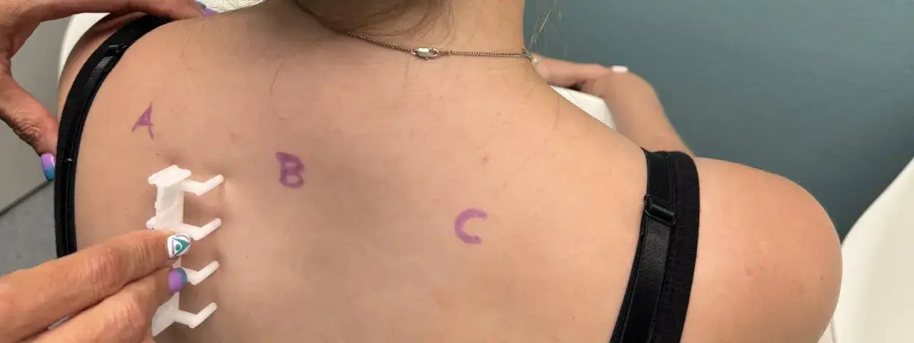 En person f&aring;r ett allergi test p&aring; ryggen. M&auml;rken med bokst&auml;verna A, B och C syns p&aring; huden.